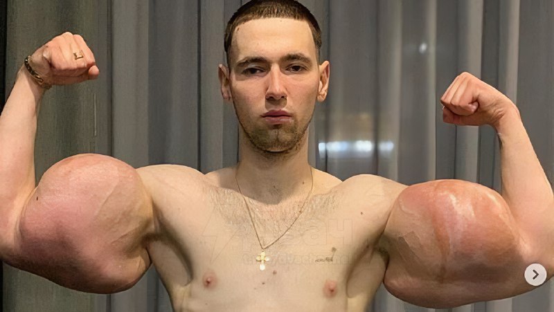 Не для слабонервных: помните, был такой Кирилл Терёшин aka «Руки-Базуки», который накачал свои бицух