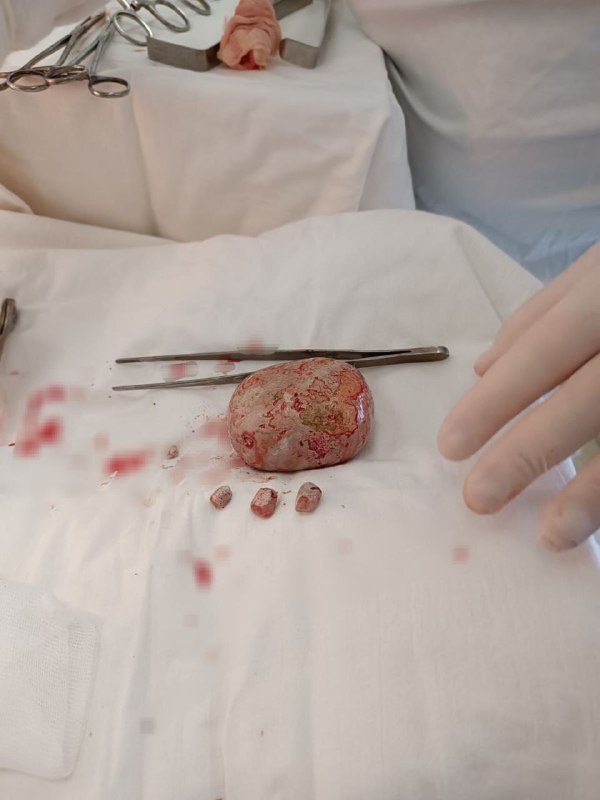 Камень весом в 1 кг достали из пациента в саратовской больнице.
Хирурги сообщили, что за 30 лет пр