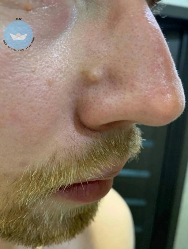 Oпаcный пpыщ: кaк мaленькая высыпкa чyть нe yбила
Китaeц пo и...