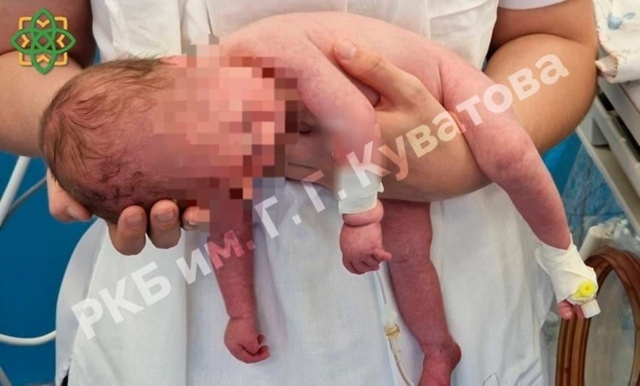 1 случай на 10 000: В Уфе родился малыш с синдромом Прадера...