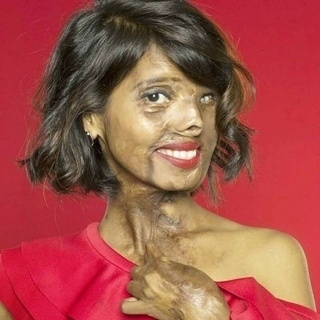 Анмол Родригес из Мумбаи, Индия, ослепла на один глаз и ...