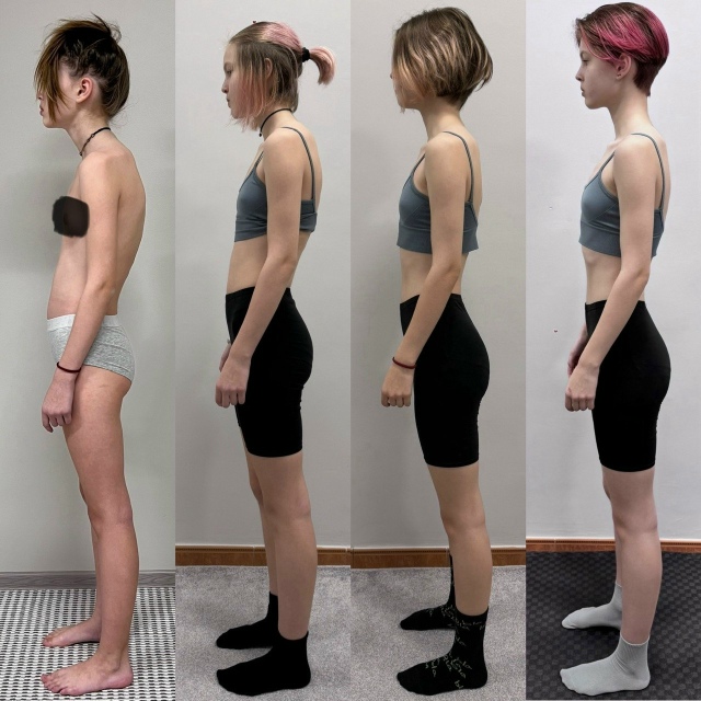 Коррекция позвоночника (сколиоз и гиперкифоз) теперь д...