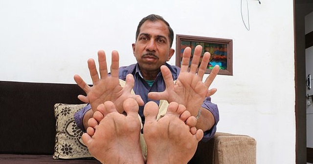 Наибольшее количество пальцев на руках и ногах
У Деве?...