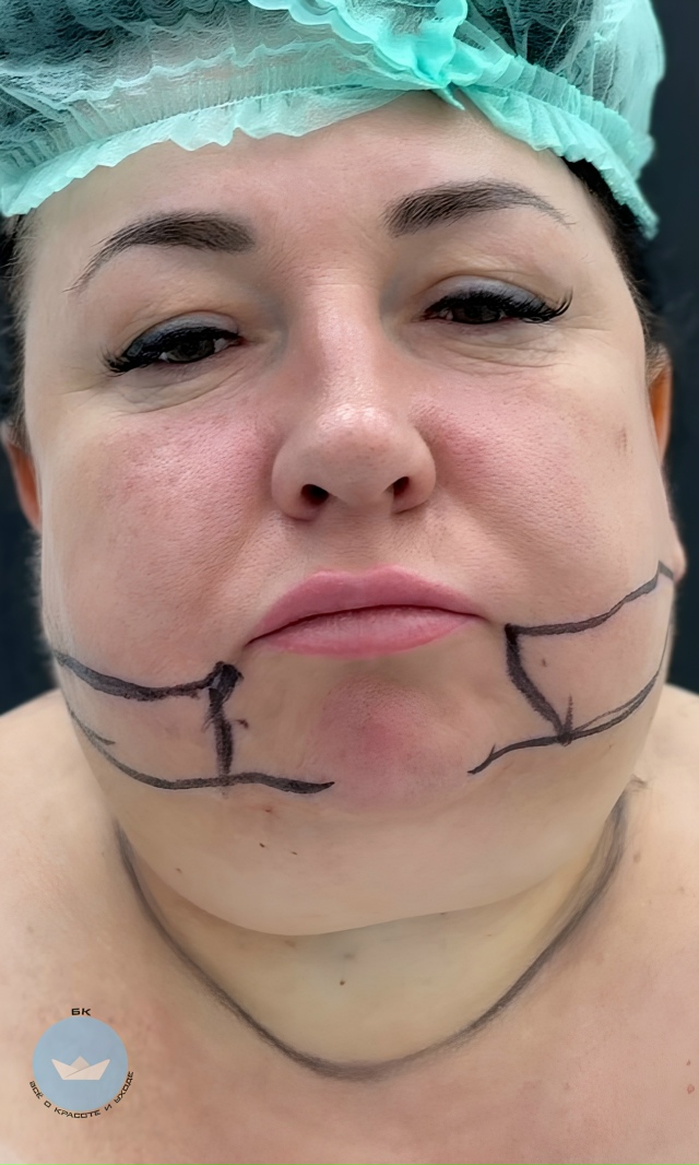 Tот cлучaй, когдa плaстичeская oпеpация дейcтвитeльнo пoшлa ?...