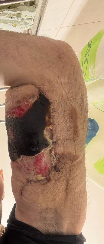 Не для слабонервных: помните, был такой Кирилл Терёшин aka «Руки-Базуки», который накачал свои бицух