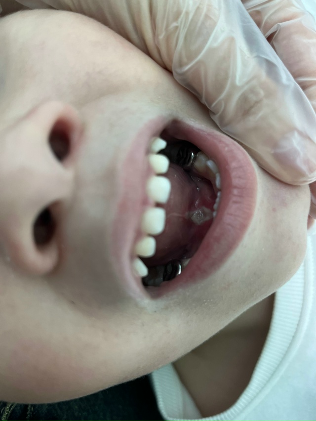 Анонимно. На фото итог операции на подъязычную уздечку...