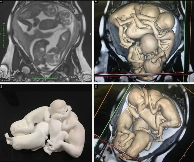 После трёх лет бесплодия у женщины обнаружили эндомет?...