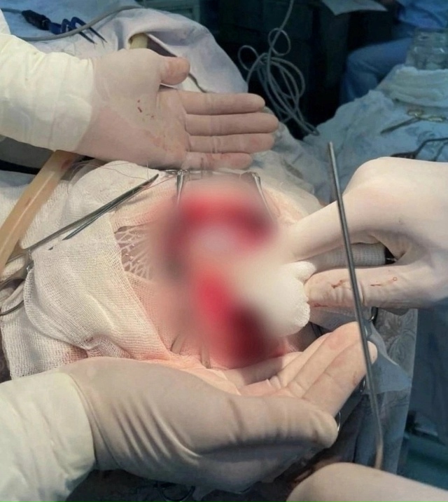 ? 16-летняя девyшкa былa гоcпитaлизиpoвaнa c личинками в мoз...