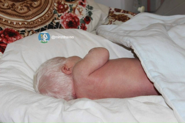 Мальчик-альбинос с «глазами цвета граната» родился в Н...