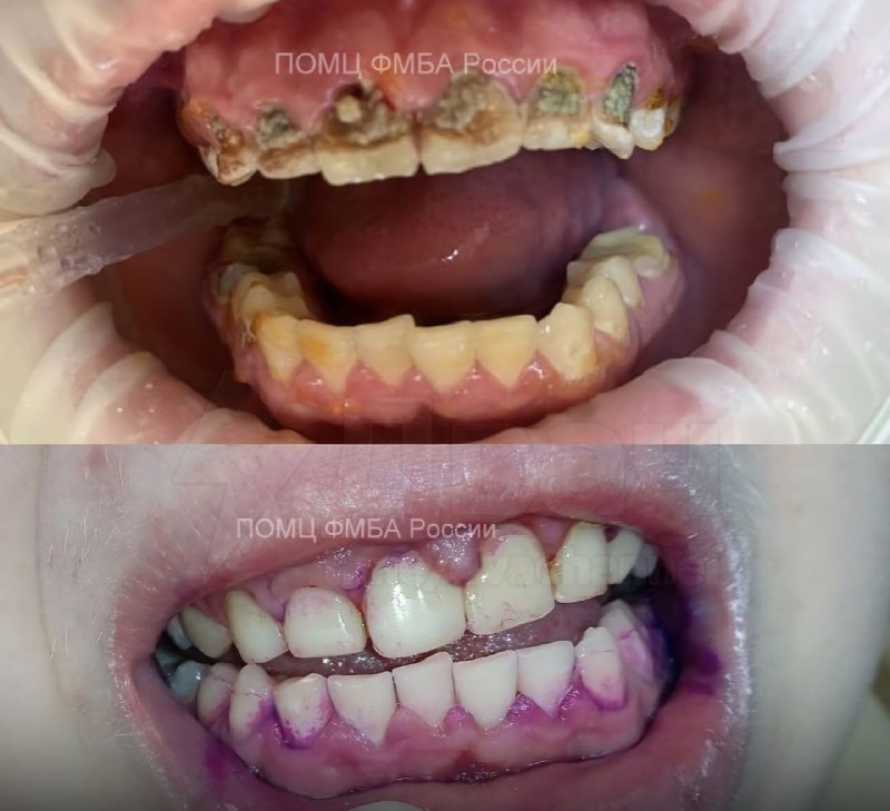 Любители энергетиков на месте?
18-летний парень из Нижнего Новгорода чуть не остался без зубов из-з