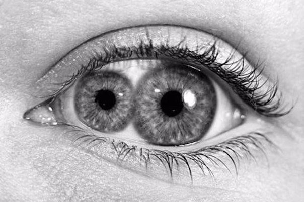 Двойной зрачок (поликория) - чрезвычайно редкое заболе?...