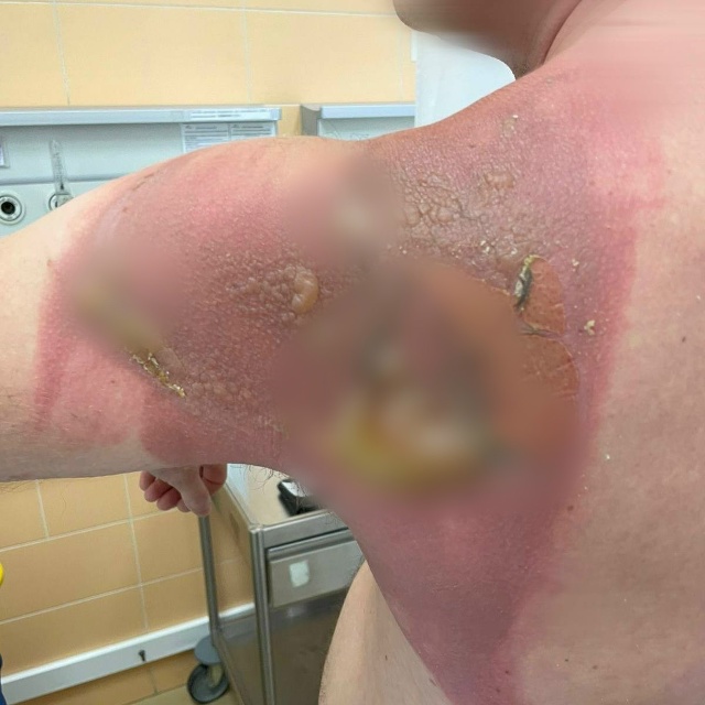 18+. Россиянин из Татарстана проснулся с химическим ожо?...