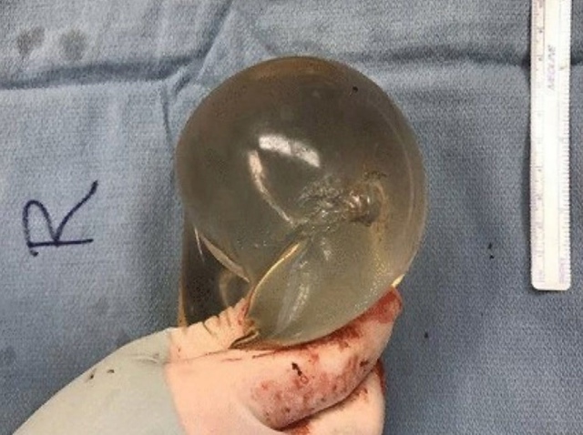 😉Силиконовый имплант стал настоящим спасителем для д...