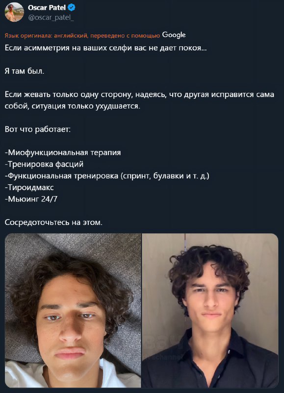 Парень исправил асимметрию лица упражнениями и сильно преобразился всего за 175 дней: он считает, чт