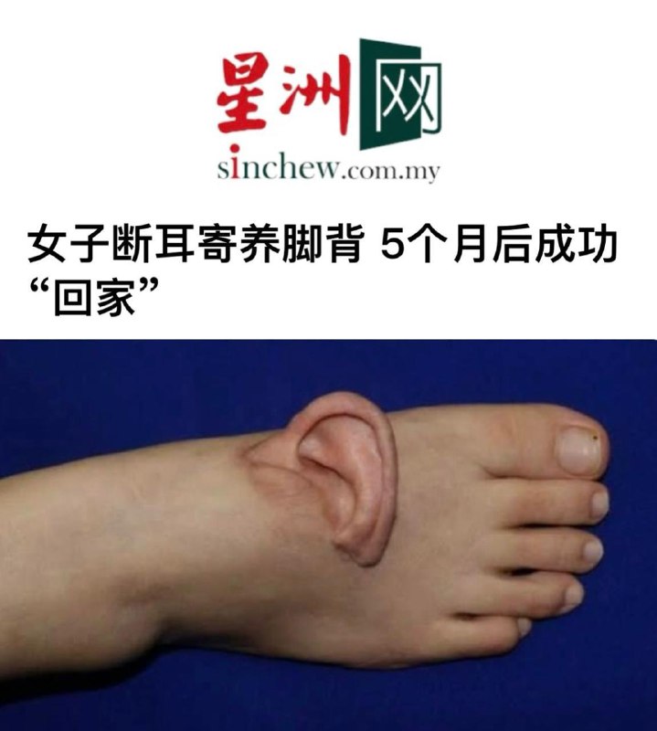 В Китае врачи пришили женщине оторванное ухо к ступне, чтобы сохранить его до пересадки.
Через пят