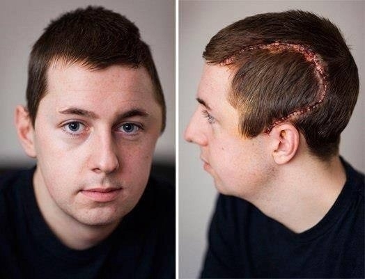 Льюис Годфри - человек перенесший самые тяжелые травмы...