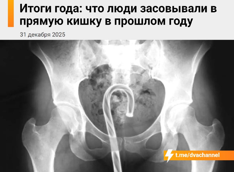 Специалисты составили ежегодный список предметов, которые «случайно» застревали внутри людей за прош