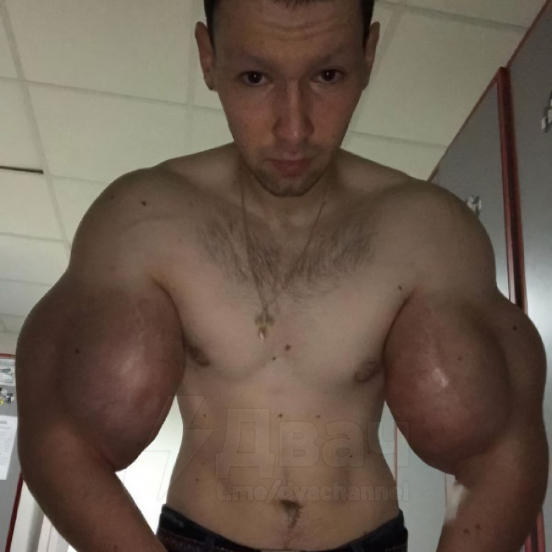 Не для слабонервных: помните, был такой Кирилл Терёшин aka «Руки-Базуки», который накачал свои бицух