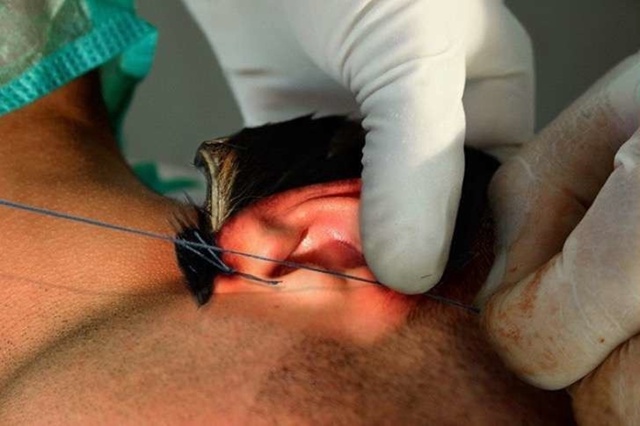 Родриго Брага из Бразилии подверг себя операции для то...