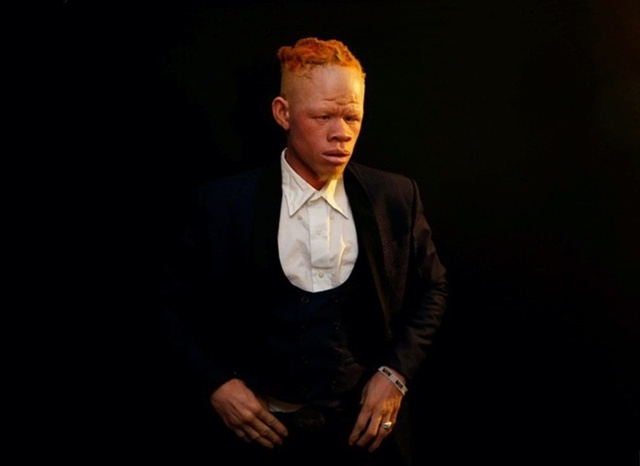 Оорганизация Albinism Society of Kenya, которая спасает альбиносо...