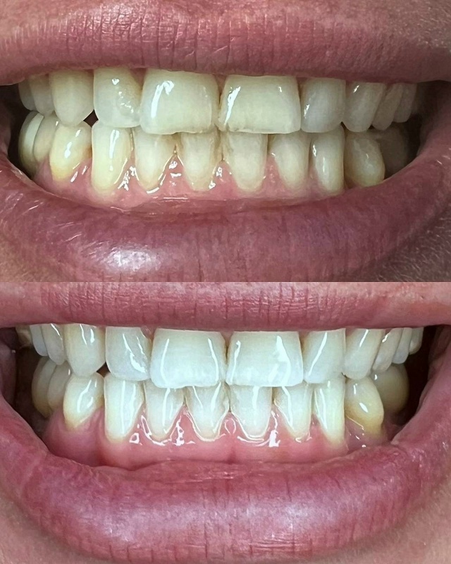 Ищем моделей на косметическое отбеливание зубов по се?...