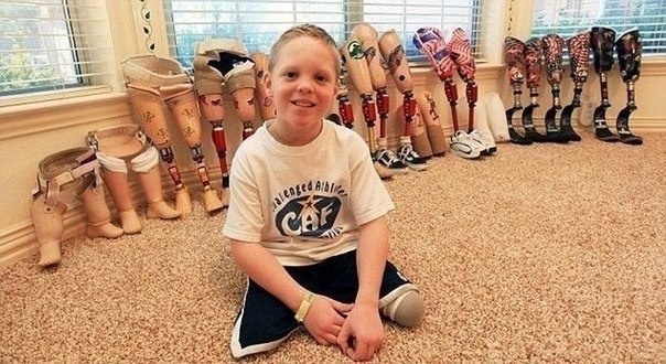 У Коди МакКасланда редкое заболевание - разновидность ...