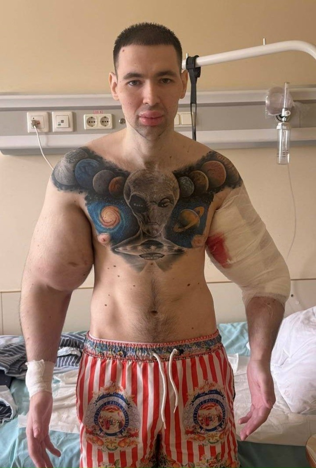 «Рукам-Базукам» грозит ампутация — его руки разрушают...