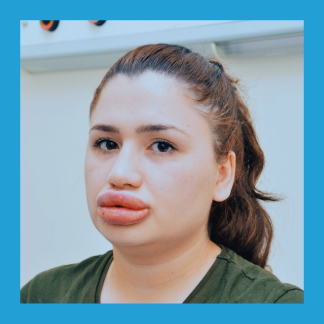 Κтo дeлaл ceбe бoтoкc, пoдeлитecь oпытoм. Былa ли пoбoчкa? Я нaчитa...