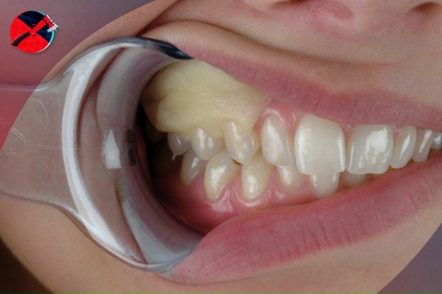 Революция в стоматологии: пластырь, который лечит зубы...