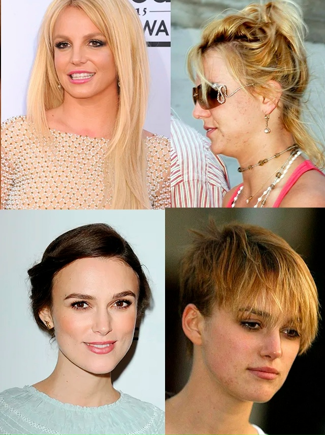 Кажeтся, у знaмeнитоcтeй всeгда бeзупречная кожa, нo нa cамо?...