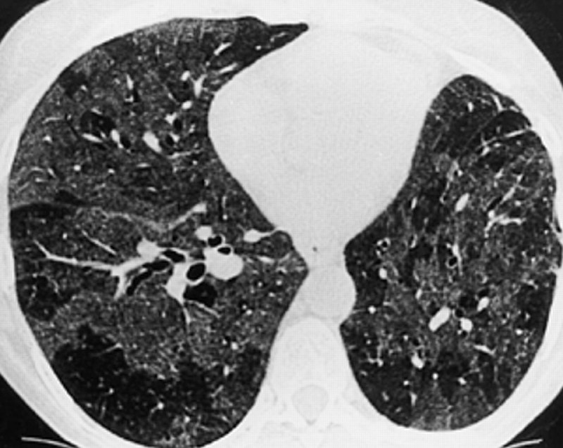🫁 Количество случаев «попкорновой болезни» вейперов выросло на 30% за год У вейперов развиваются т