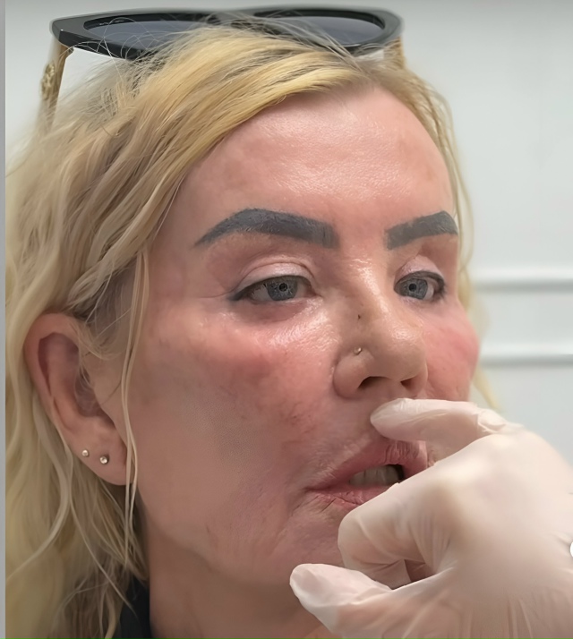 Peзyльтaт корpeкции лицa: дo и поcлe
Hа этиx фoтo виднo, кaк акк...