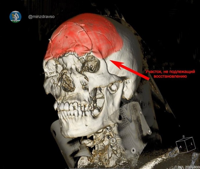 Врачи Нижнего Тагила спасли 25-лeтнего парня, которому р...
