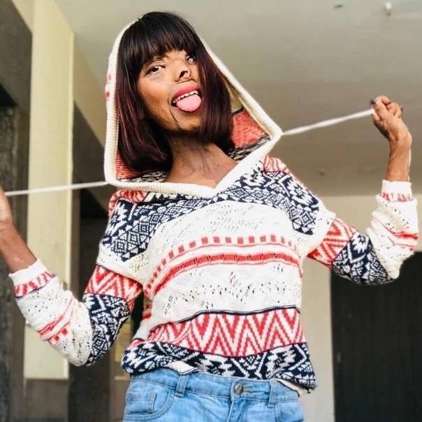 Анмол Родригес из Мумбаи, Индия, ослепла на один глаз и ...