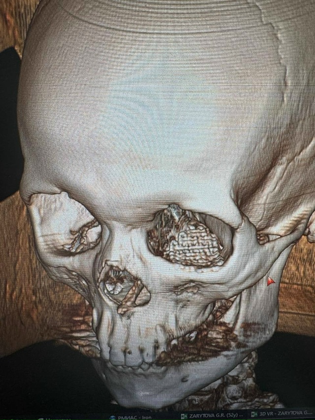 ?❤В Башкирии врачи успешно восстановили часть лица б...