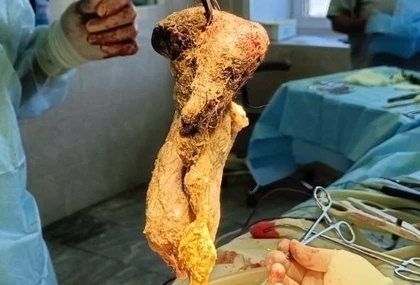 ? Гигантский ком волос достали из желудка школьницы.
...