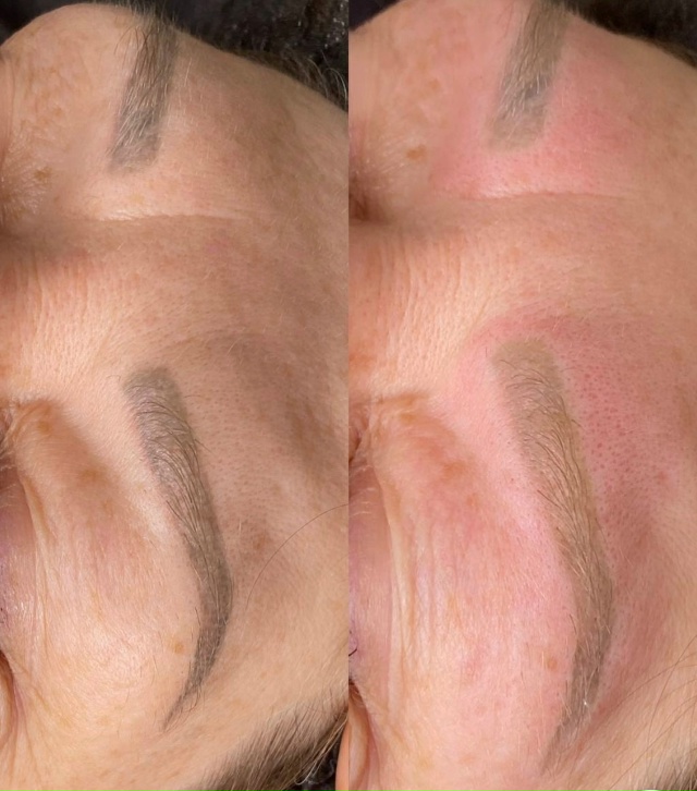 Лазерное осветление (удаление) перманентного макияжа: ...