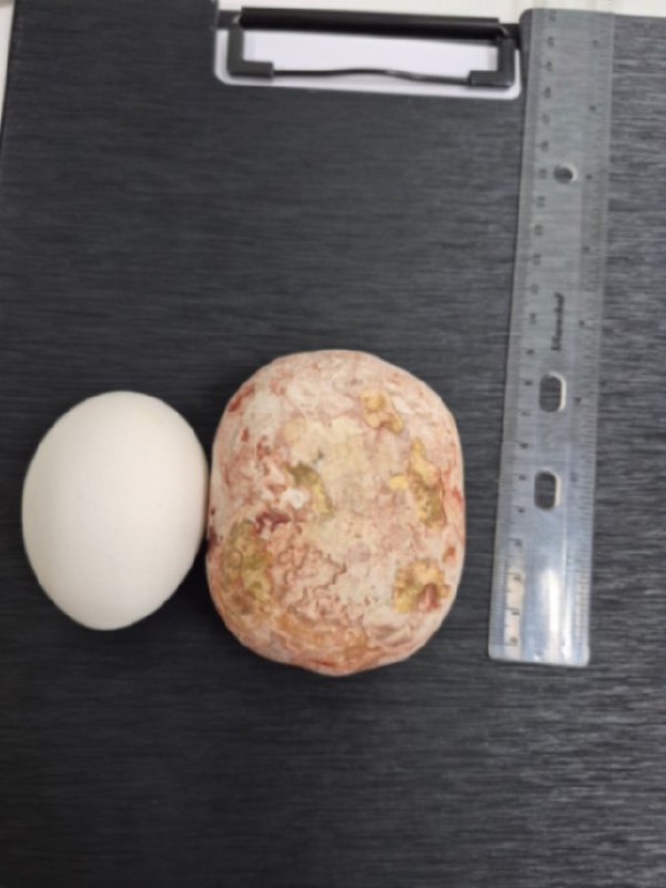 Камень весом в 1 кг достали из пациента в саратовской больнице.
Хирурги сообщили, что за 30 лет пр