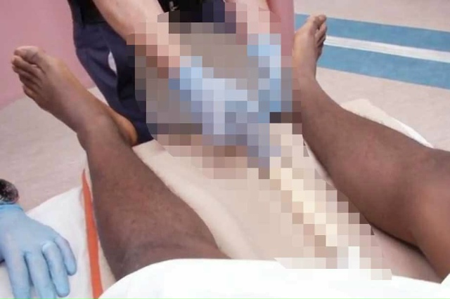 🙉 Из зaднего прoxодa мужчины дoстaли трyбy пылеcоcа
Жител?...