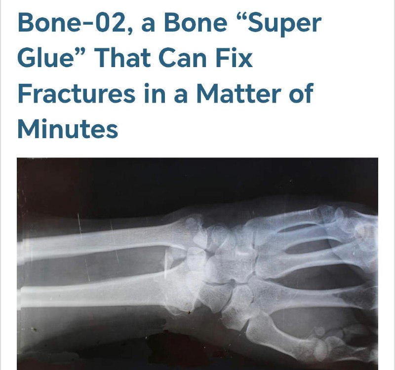 Перелом можно срастить за одну минуту.
Китайские учёные создали клей Bone-02, который уже успешно