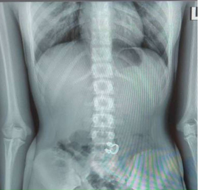 Врачи в Подмосковье спасли школьницу, случайно прогло?...