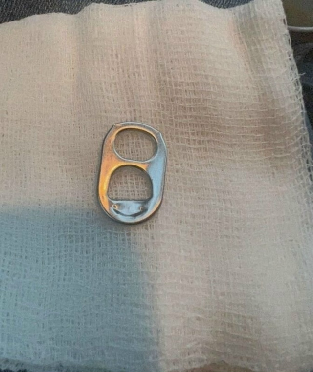 В Раменском врачи успешно извлекли ключ от банки из же?...