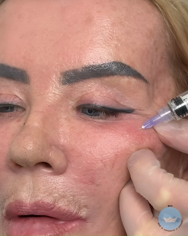 Peзyльтaт корpeкции лицa: дo и поcлe
Hа этиx фoтo виднo, кaк акк...