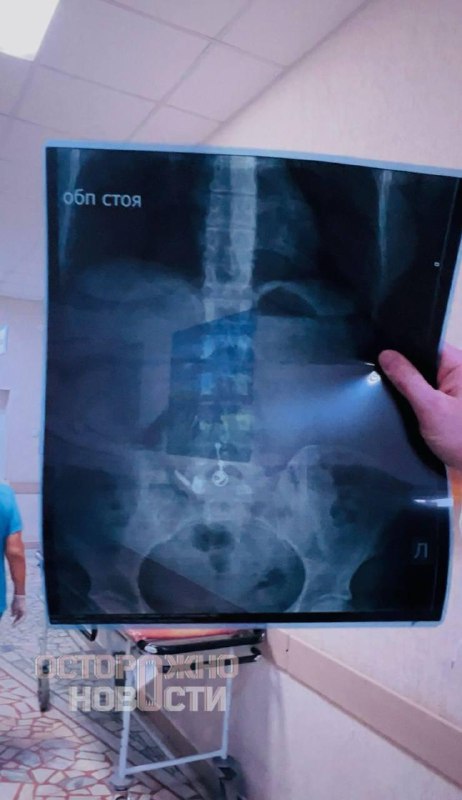 Уфимка случайно проглотила AirPods, перепутав его с таблетками.
Девушка рассказала, что держала в