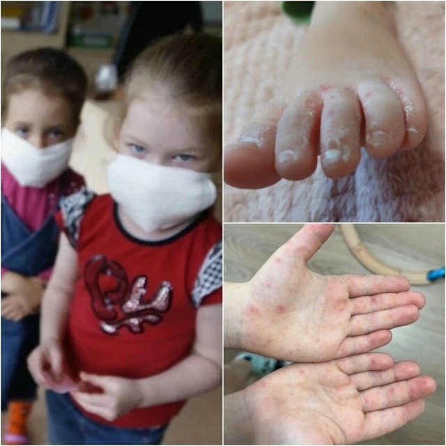 Вирус Коксаки атакует детей по всей России!
В России н?...