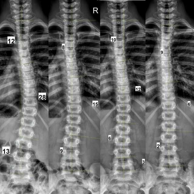 Коррекция позвоночника (сколиоз и гиперкифоз) теперь д...