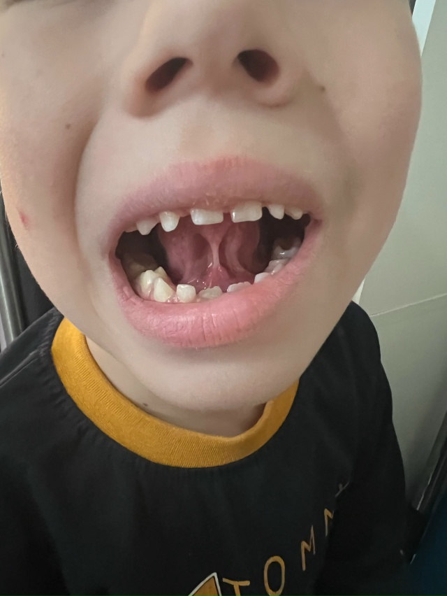 Здравствуйте! Извечный вопрос резать или нет ?) в 3 года ...