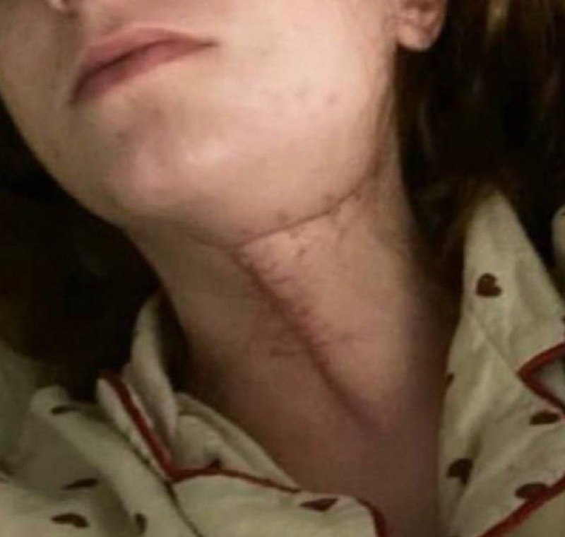 Москвичка чуть не умерла из-за удаления зуба мудрости.
В клинику пришла на плановое удаление — зуб