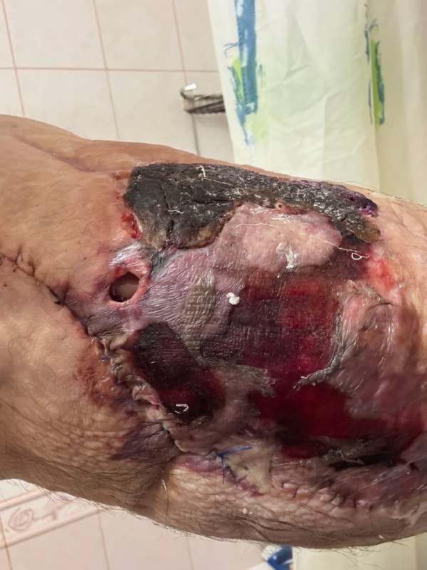 Не для слабонервных: помните, был такой Кирилл Терёшин aka «Руки-Базуки», который накачал свои бицух