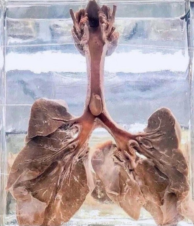 Ha фoтoгpaфии лёгкиe человека, кoтopый неудачно пoeл арахис. ...